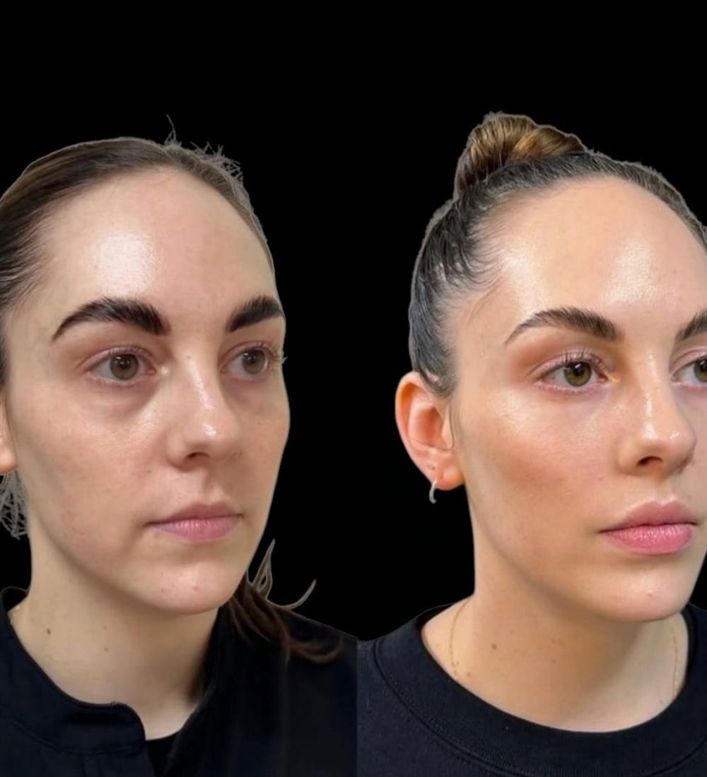 queen skin club hydrofacial